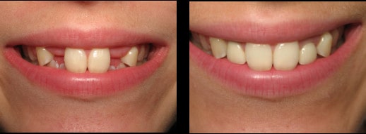 extreme close up before and after of child's teeth after getting full arch implants