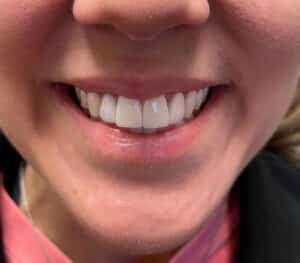 After Image: Cosmetic Dentistry – Case 19