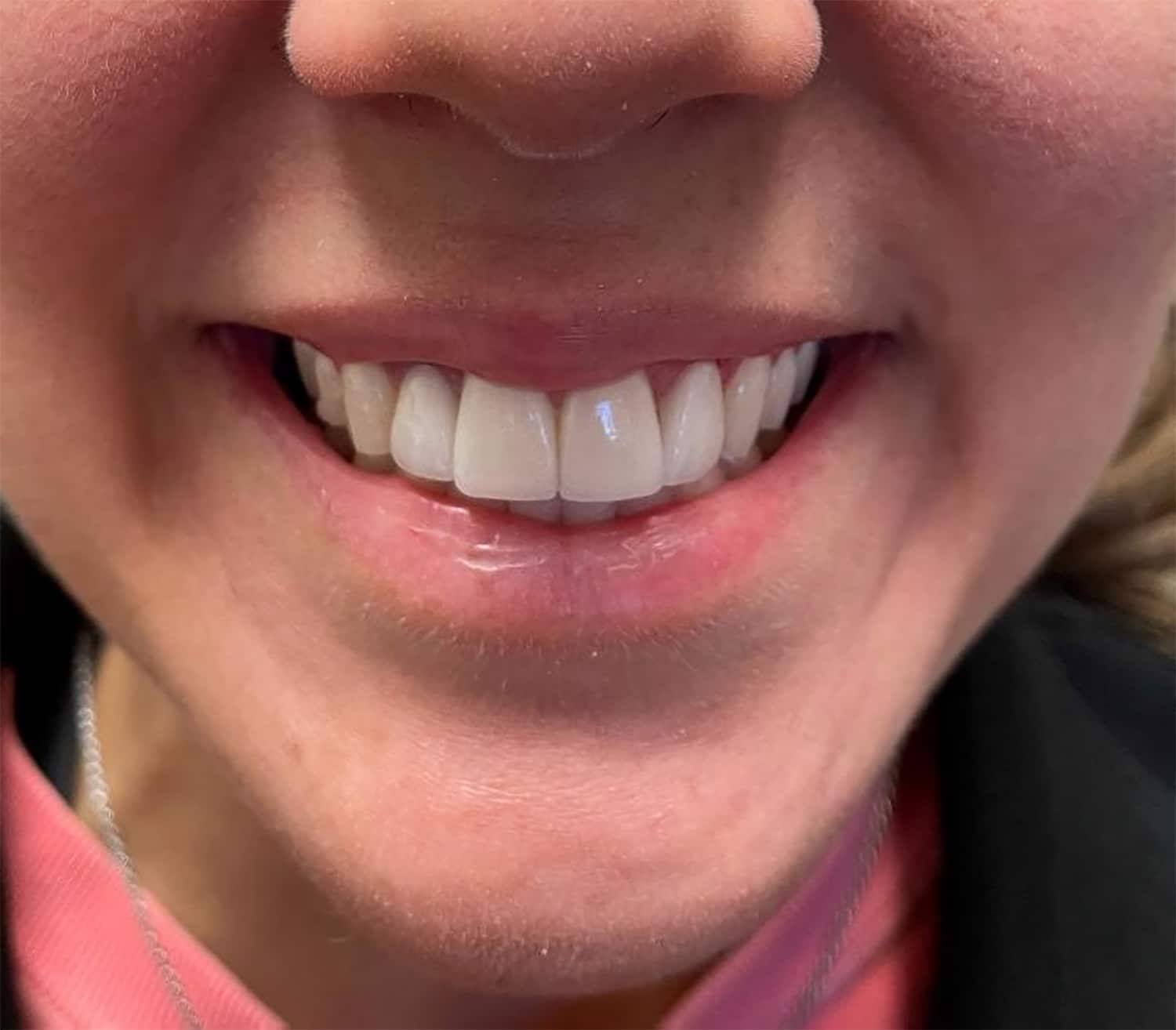 After Image: Cosmetic Dentistry – Case 19 - front