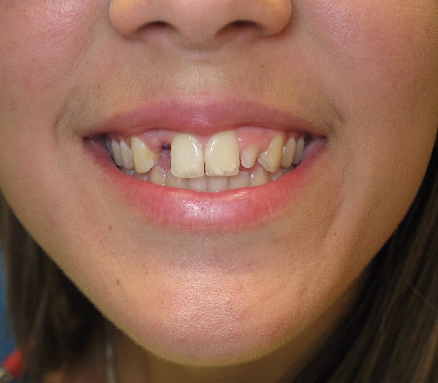 Before Image: Cosmetic Dentistry – Case 19 - front