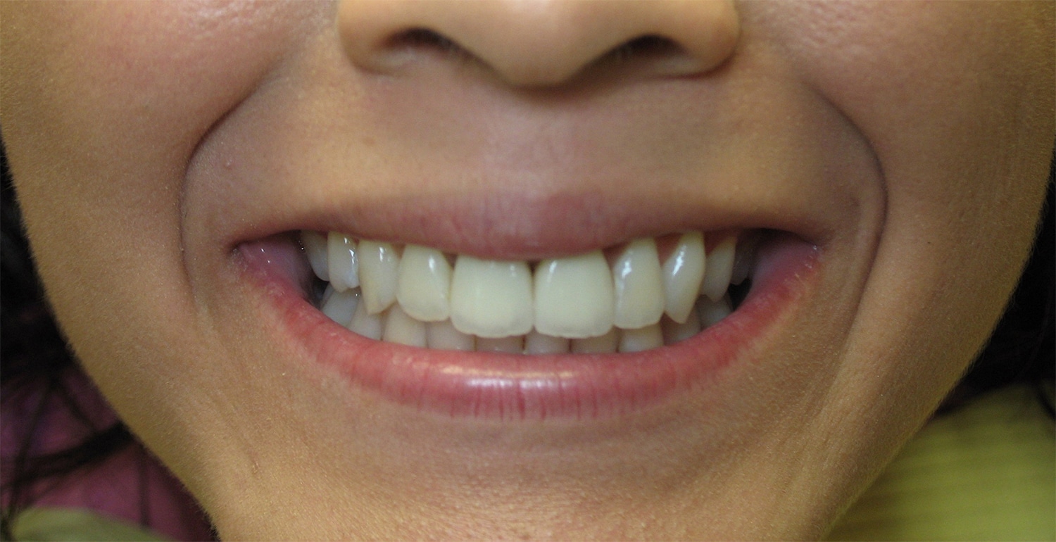 After Image: Cosmetic Dentistry – Case 20 - front