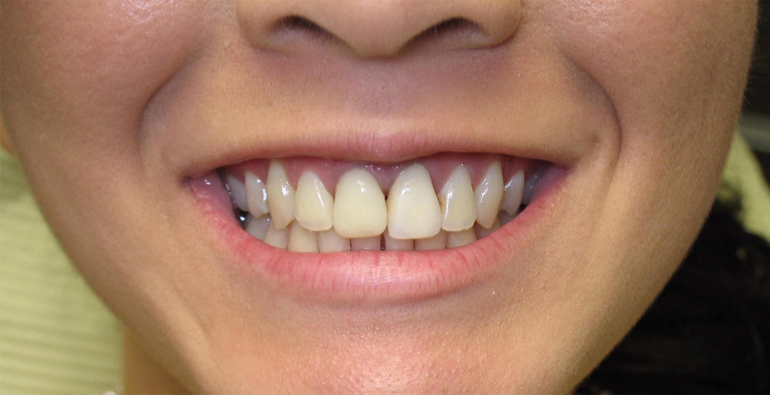 Before Image: Cosmetic Dentistry – Case 20 - front