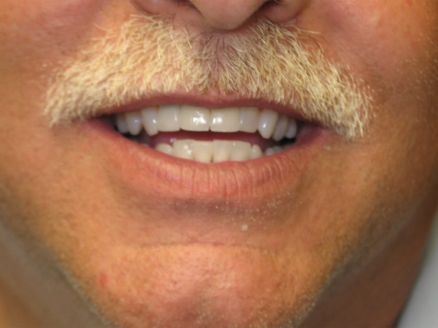 After Image: Cosmetic Dentistry – Case 21 - front