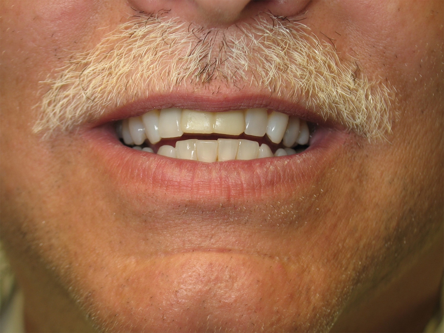 Before Image: Cosmetic Dentistry – Case 21 - front