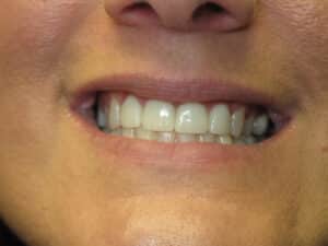 Cosmetic Dentistry – Case 22