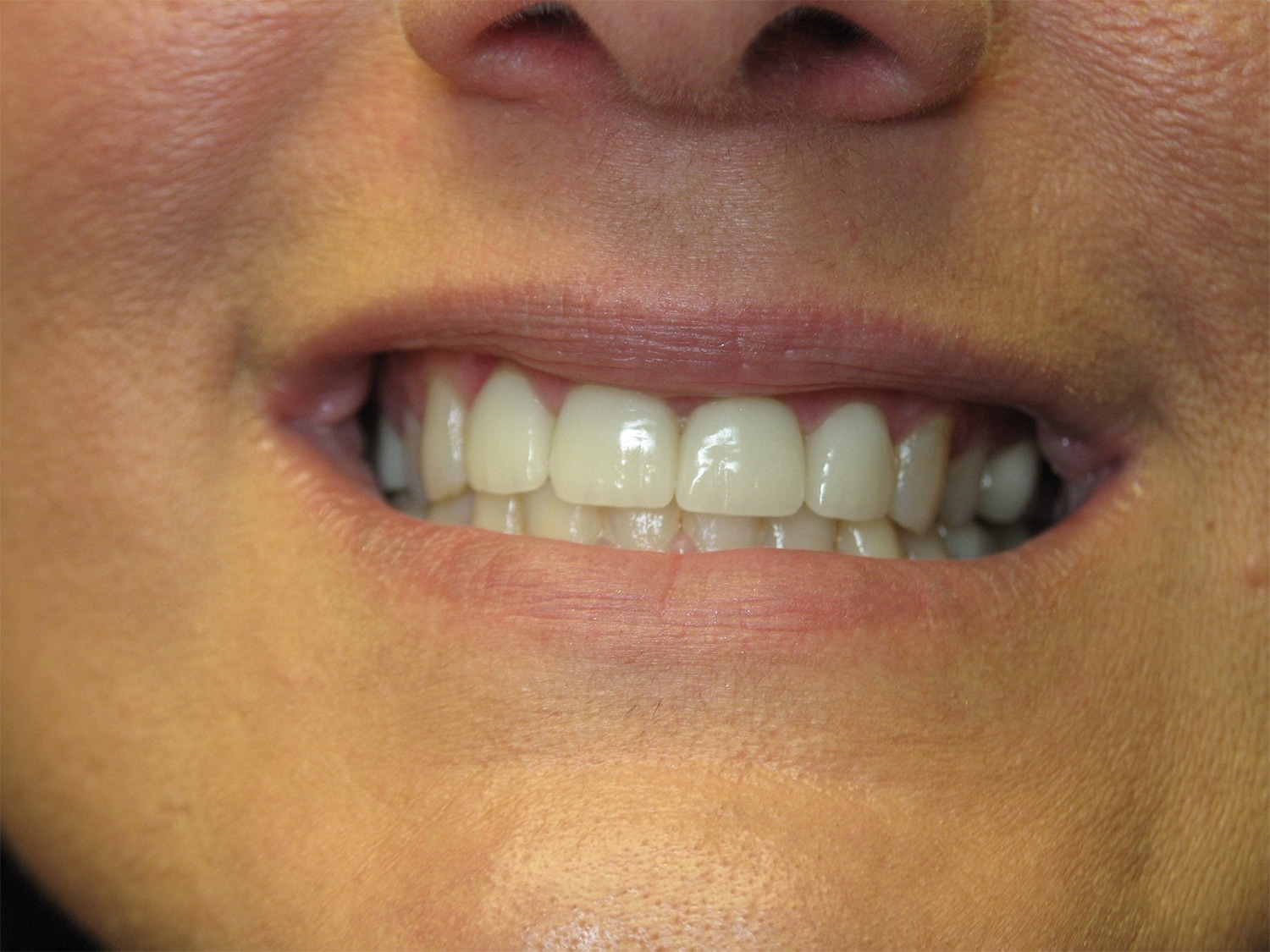 After Image: Cosmetic Dentistry – Case 22 - front