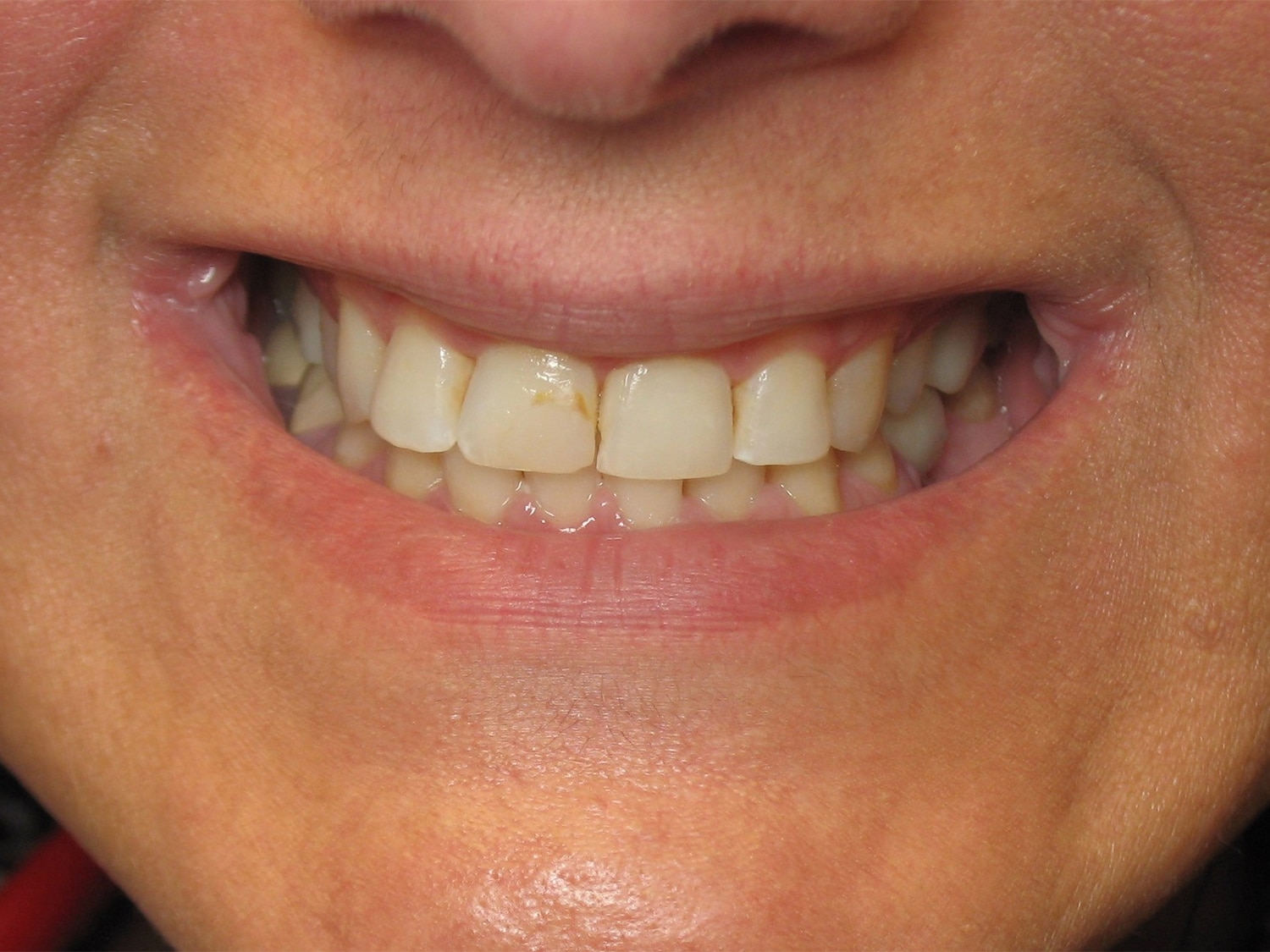Before Image: Cosmetic Dentistry – Case 22 - front