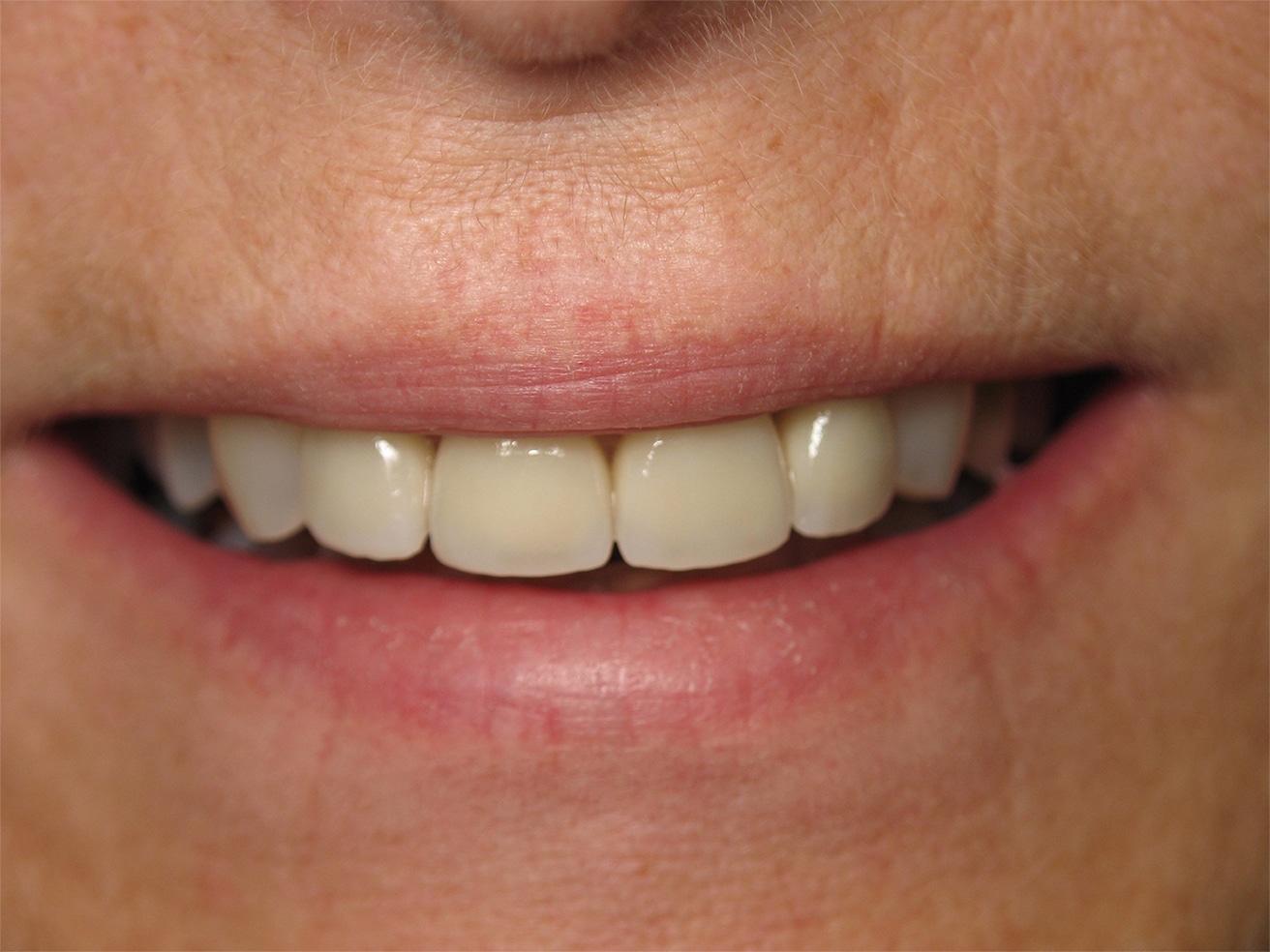After Image: Cosmetic Dentistry - front