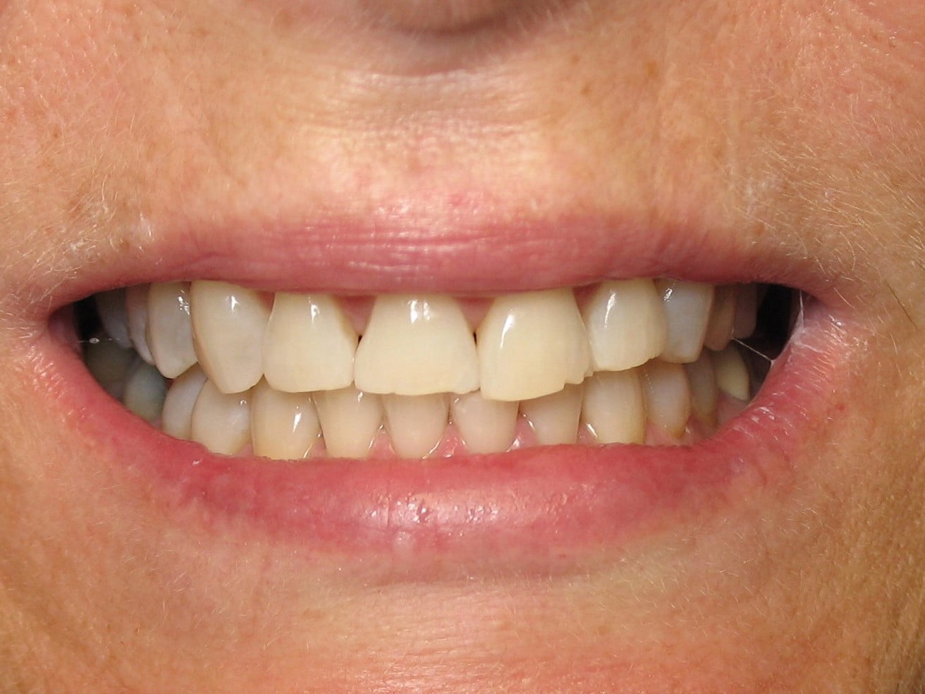 Before Image: Cosmetic Dentistry - front