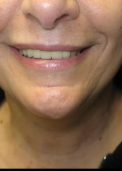 After Image: Cosmetic Dentistry – Case 18 - front