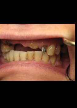 Before Image: Cosmetic Dentistry – Case 18 - front