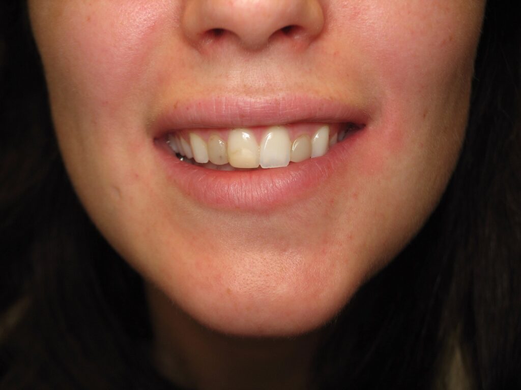 Before Image: Restorative - front