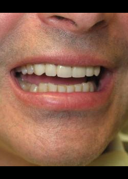 Cosmetic Dentistry – Case 13