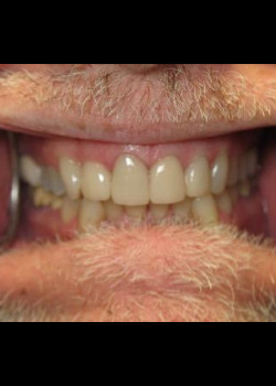 Cosmetic Dentistry – Case 14