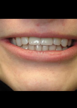 Cosmetic Dentistry – Case 15