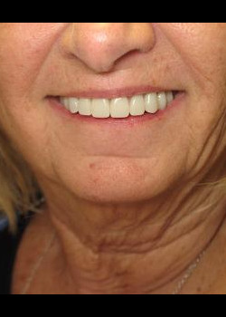 Dental Implants – Case 10