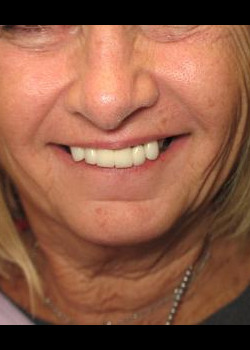 Dental Implants – Case 10