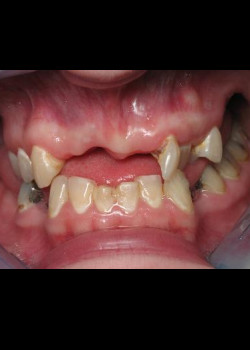 Full Mouth Reconstruction – Case 5