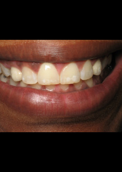 Dental Implants – Case 1