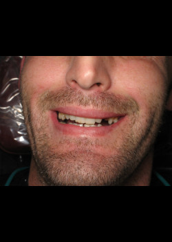 Dental Implants – Case 2