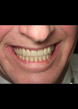Full Mouth Reconstruction – Case 1