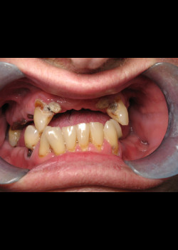 Full Mouth Reconstruction – Case 1