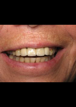 Cosmetic Dentistry – Case 1