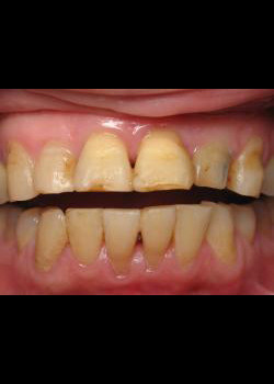 Cosmetic Dentistry – Case 1