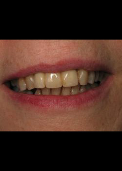 Cosmetic Dentistry – Case 2