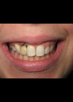 Dental Implants – Case 4