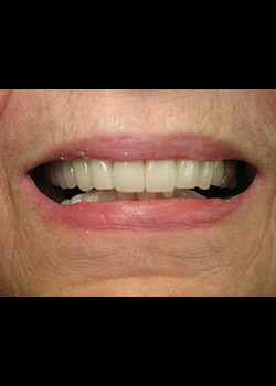 Full Mouth Reconstruction – Case 2
