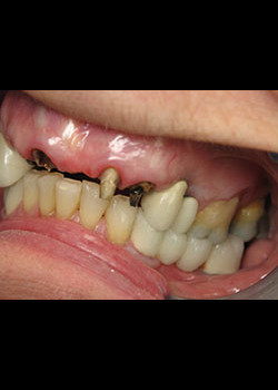 Full Mouth Reconstruction – Case 2
