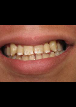 Cosmetic Dentistry – Case 4