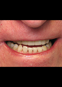 Cosmetic Dentistry – Case 5