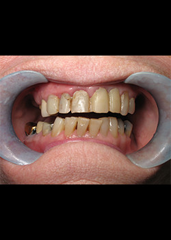 Cosmetic Dentistry – Case 6