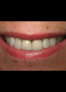 Cosmetic Dentistry – Case 7