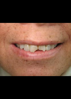 Cosmetic Dentistry – Case 7