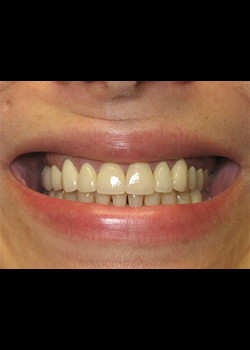 Cosmetic Dentistry – Case 9