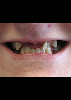 Full Mouth Reconstruction – Case 3