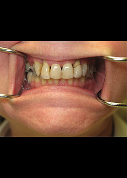 Cosmetic Dentistry – Case 10