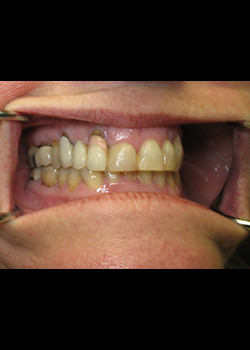 Cosmetic Dentistry – Case 11