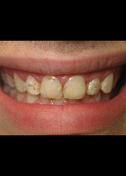Cosmetic Dentistry – Case 12
